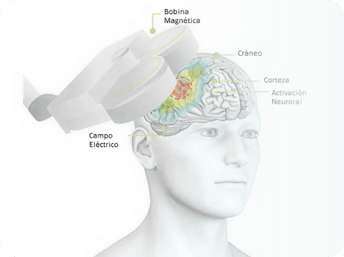 Estimulación magnética transcraneal (TMS)