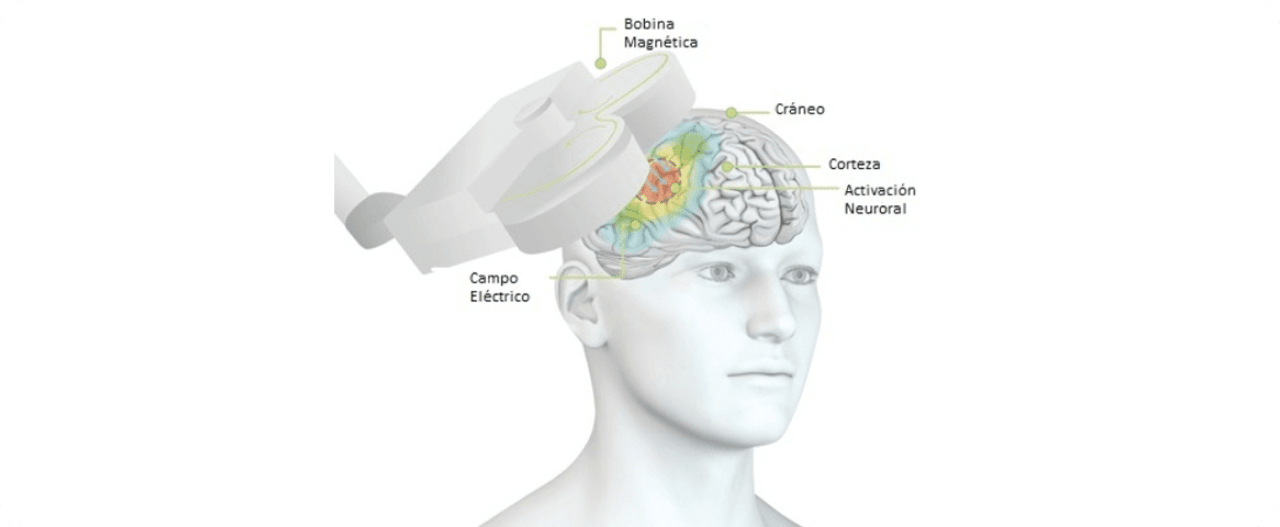 rTMS: Tratamiento para Alzheimer y Demencia