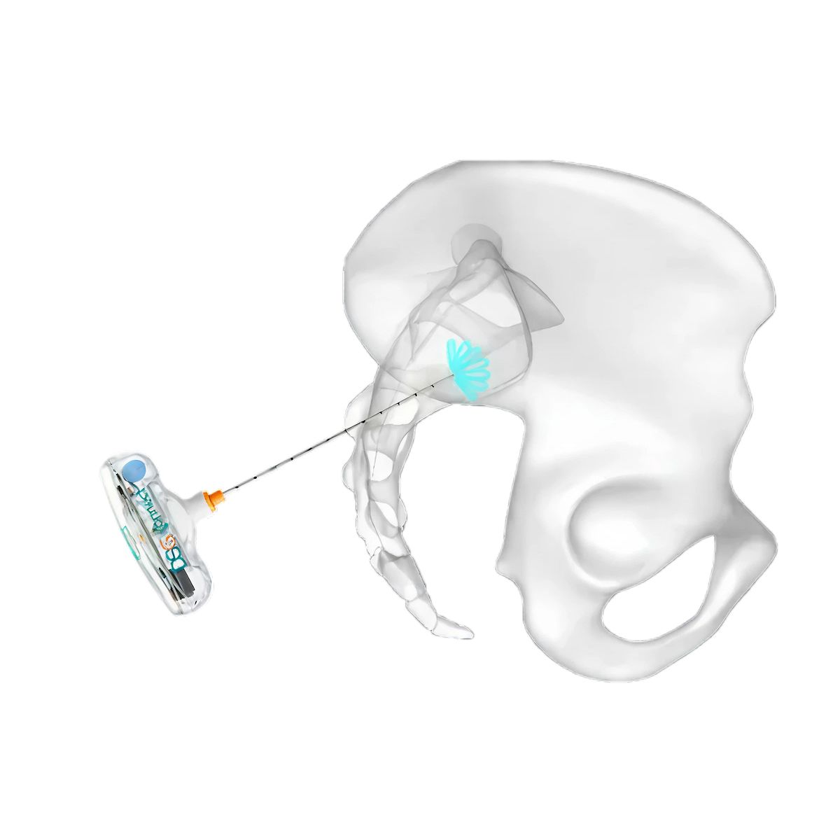 Guía dinámica SI — Sonda DSG pedicular PsiFGuard