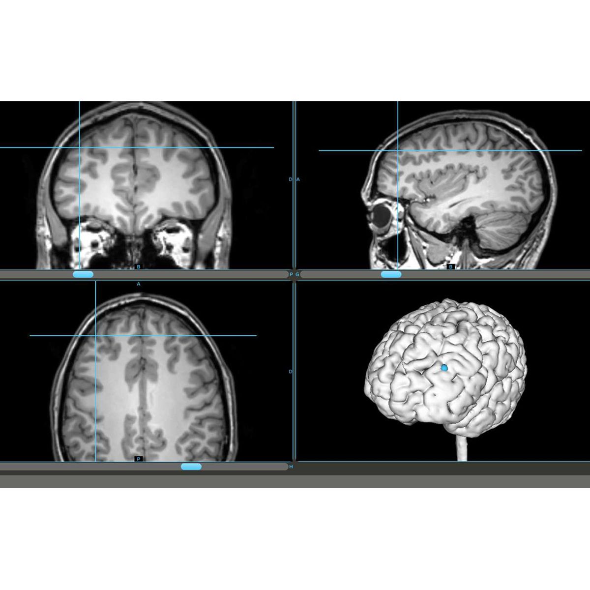 Neuronavegador TMS clínico Syneika One