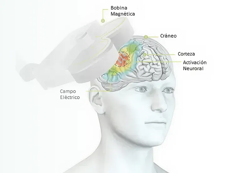 Estimulación magnética transcraneal (TMS)